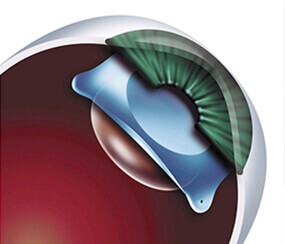 Cataract Surgery Treatment in Hyderabad