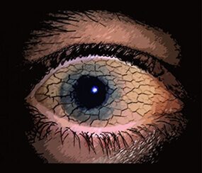 Lasik Surgery Treatment in Hyderabad