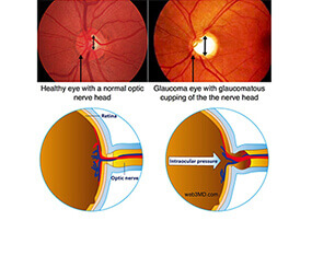 Lasik Surgery Treatment in Hyderabad