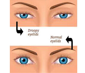 Lasik Surgery Treatment in Hyderabad